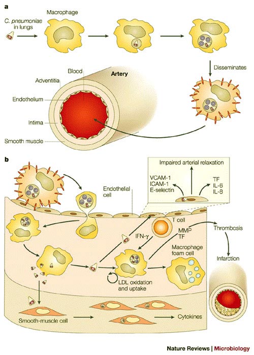 Chlamydia Pneumoniae arteriosclerosis