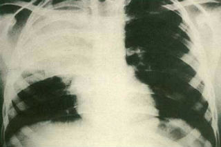 X-ray photograph of Chlamydia Pneumoniae